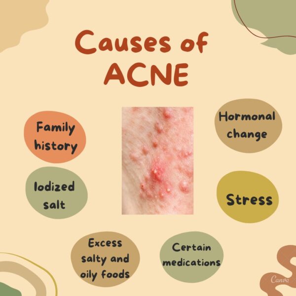 Causes of acne