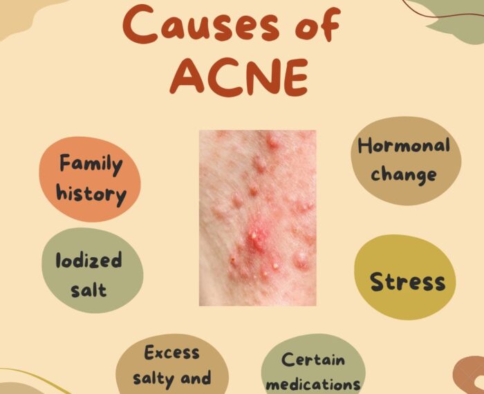 Causes of acne