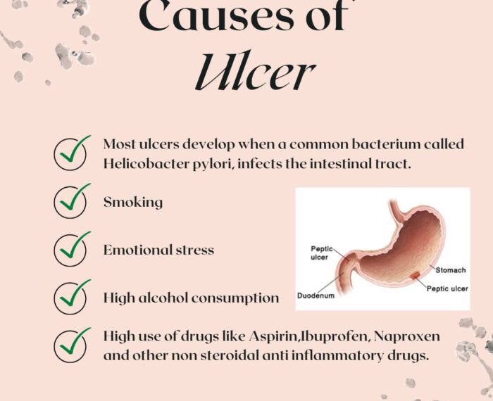 Causes of ulcer