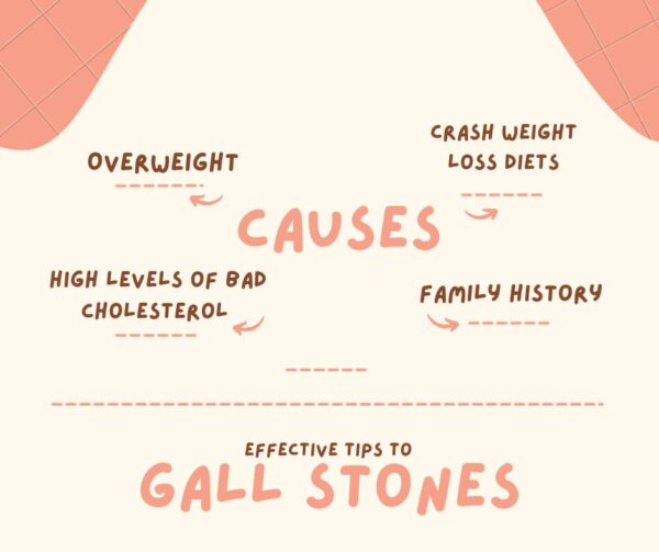 Causes of gall stones