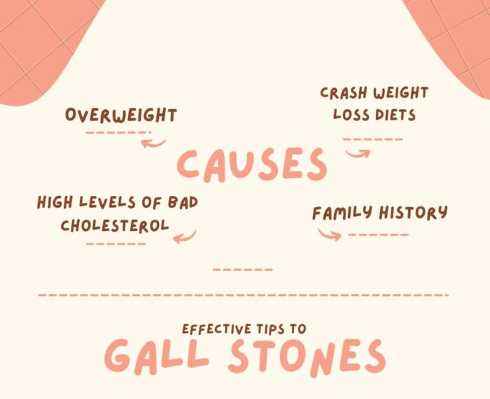 Causes of gall stones